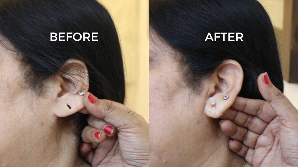 Ear Hole Repair The Best Auroplasty Clinic In India
